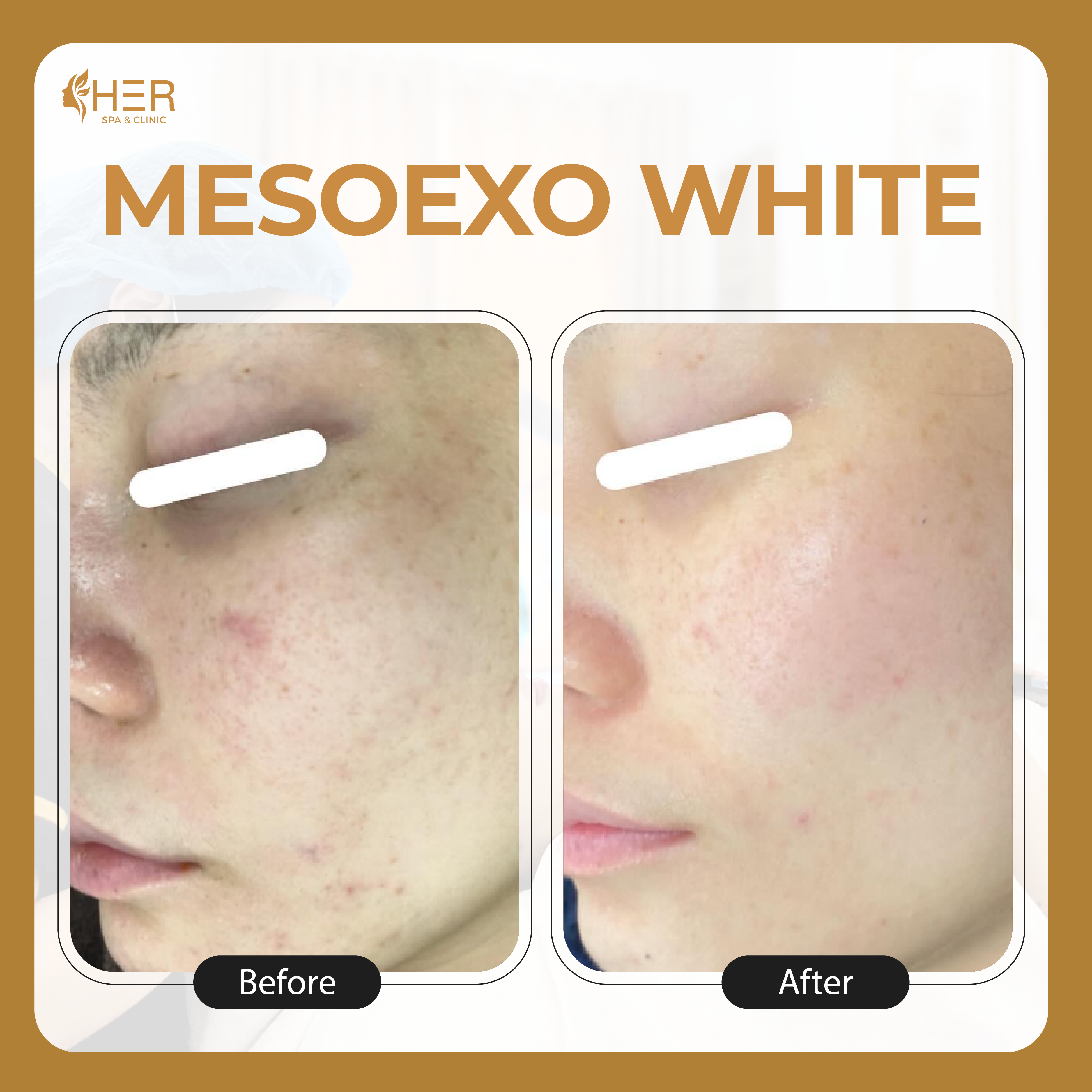 Mesoexo White - Mesotherapy tế bào gốc & sáng da